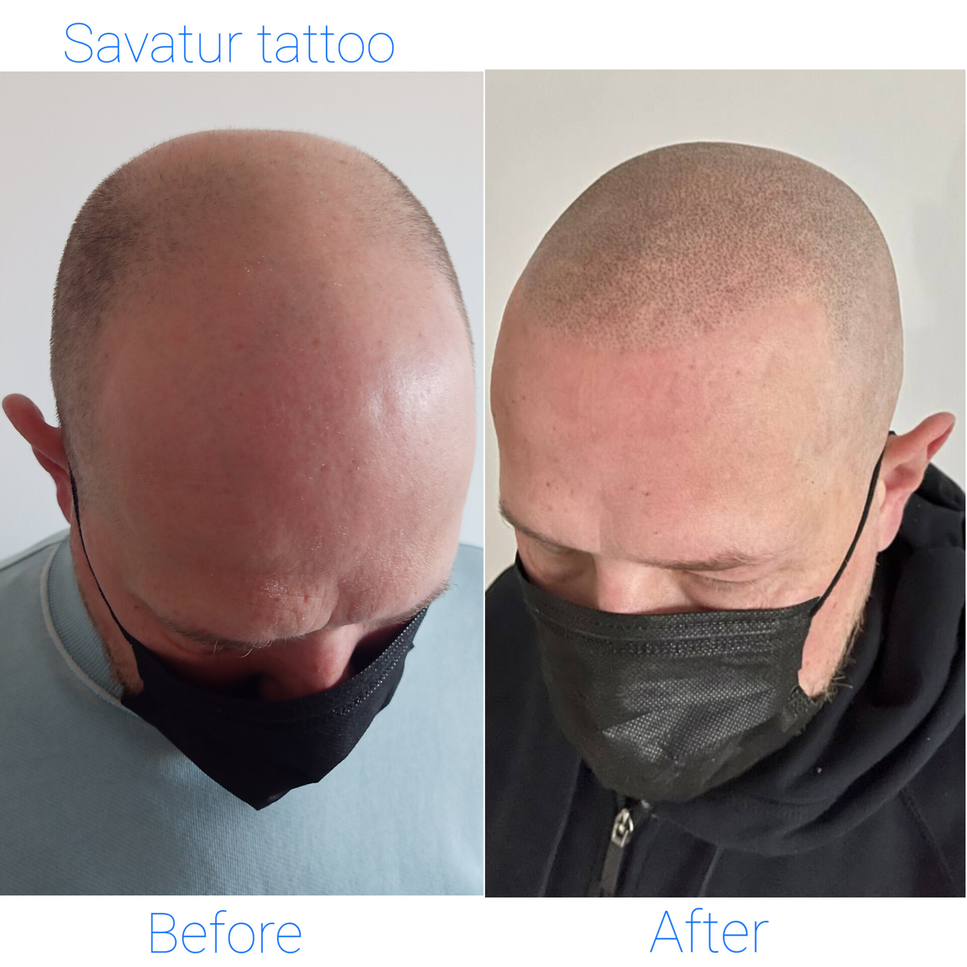 Scalp Micropigmentation (SMP) - Hairline correction