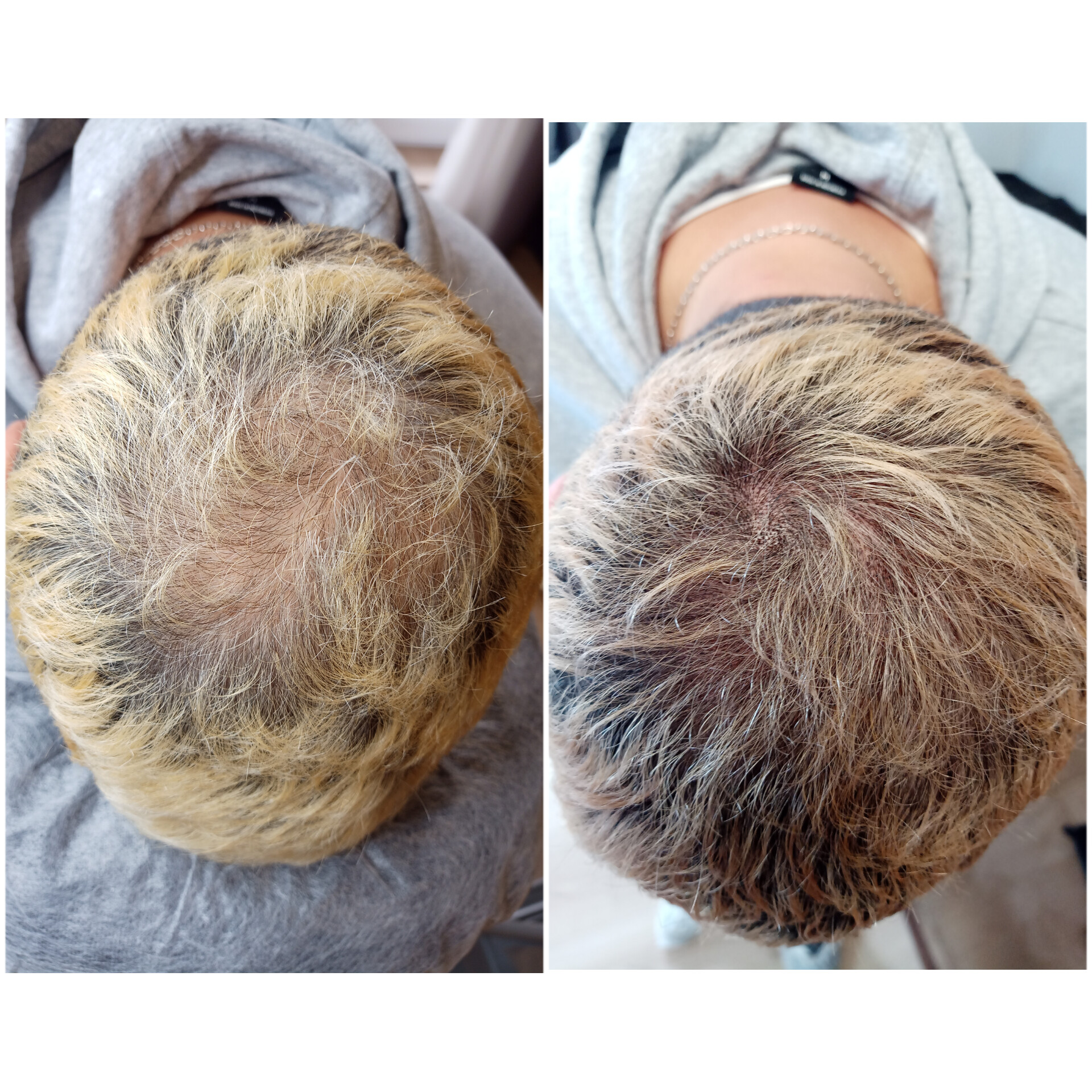 Трихопигментация SPM - Восстановление густоты волос